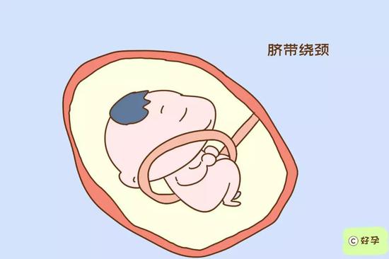 什么是脐带绕颈，B超提示很清楚